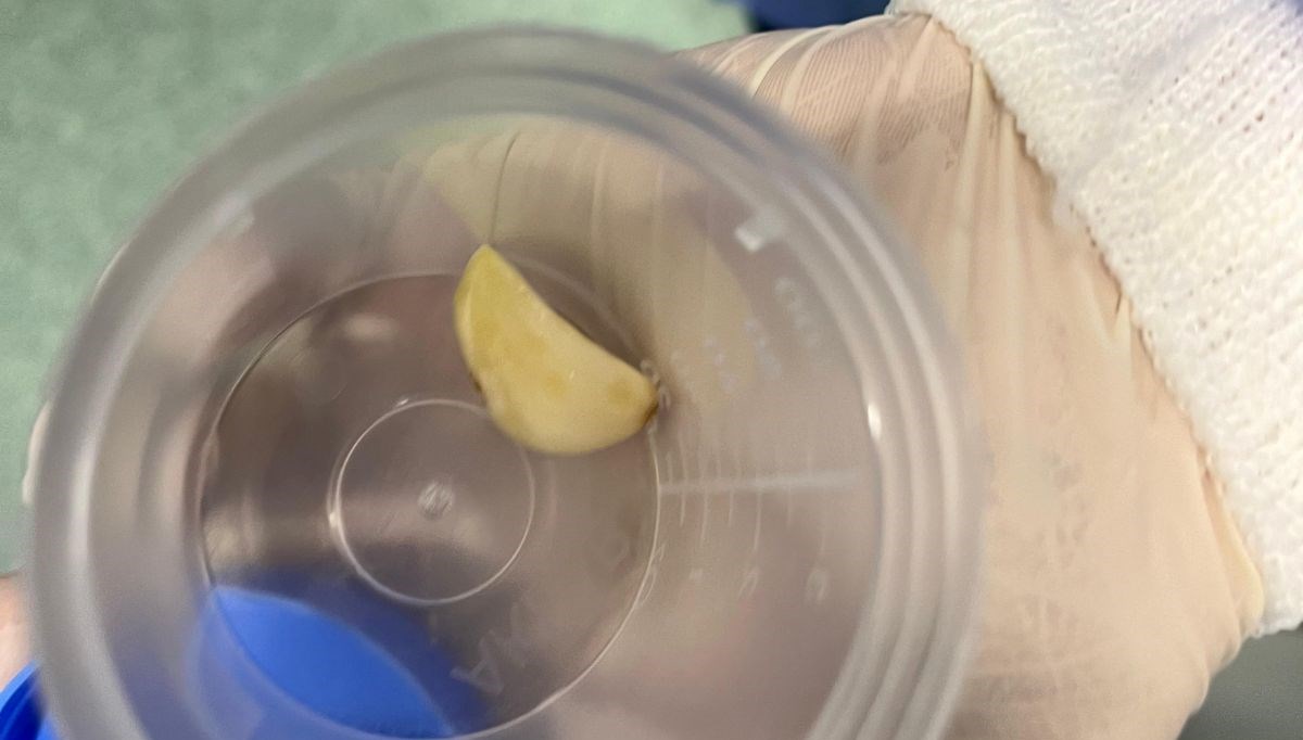 akcigerine sarimsak kacti ameliyat ile cikarildi f4bhiixa