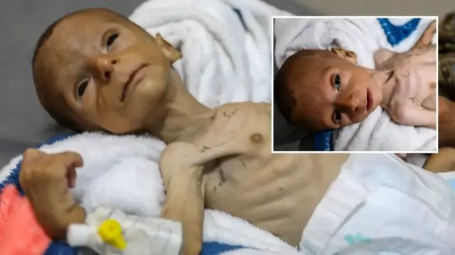 yetersiz beslenme nedeniyle gazzede 2 aylik bebegin yasami tehdit altinda 1V19RfvK