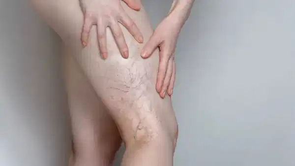 uzmanindan uyari ileri derecedeki varis hayati tehdit edebilir gymqkyVL.jpg